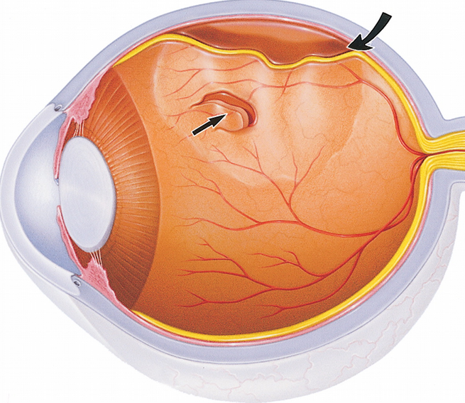 Jelly In The Eyeball Does It Cause Shadows In Your Vision? Part 3